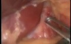 Laparoscopic Adjustable Silicone Gastric Band - BMI 46 Patient