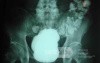 Sigmoid Diverticulitis - Colovesical Fistula (2 of 8)