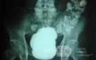 Sigmoid Diverticulitis - Colovesical Fistula (2 of 8)