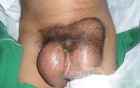 Bilateral Inguinal Hernia   