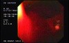 Acute Variceal Bleeding - First Look at the Esophagus