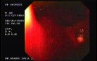 Acute Variceal Bleeding - First Look at the Esophagus