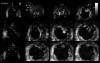 Left Ventricular Noncompaction in 3D Echocardiography, Video nr 1