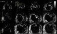 Left Ventricular Noncompaction in 3D Echocardiography, Video nr 1