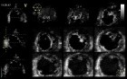 Left Ventricular Noncompaction in 3D Echocardiography, Video nr 1