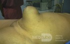 Umblical Hernia