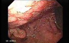 Primary Gastric Lymphoma Following Kidney Transplantation - 40 Years-Old Woman