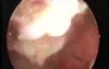 Hysteroscopic Treatment Of Intrauterine Myoma