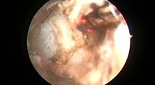 Greenlight HPS Prostatectomy - Bleeding