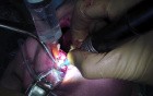 Bone Graft - Block Ramus Graft Fixation And Closure