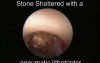Endoscopic Lithotripsy Procedure