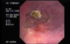 Barrett's Esophagus 