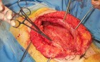Abdominal closure after laparostomy