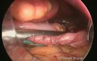 Obesity Surgery - Laparoscopic Sleeve Gastrectomy 