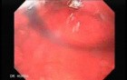 Scirrhous Gastric Carcinoma - Endoscopy (17 of 47)