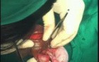 Orchidectomy And Orchidepexy Due To Testicular Torsion