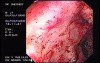 Radiation Proctosigmoiditis (1 of 14)