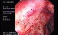 Radiation Proctosigmoiditis (1 of 14)