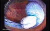 Sessile Tubulovillous Adenoma (4 of 11)