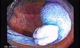 Sessile Tubulovillous Adenoma (4 of 11)