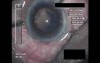 Cataract Surgery XI - Part 3
