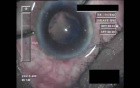 Cataract Surgery XI - Part 3