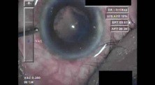 Cataract Surgery XI - Part 3