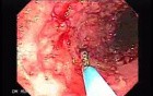 Colitis Ulcerosa - Pseudopolyps (15 of 22)