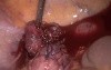 Laparoscopic suturing of rectal prolapse