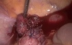 Laparoscopic suturing of rectal prolapse