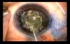 Capsulotomy in a small eye with use of Fugo Blade 