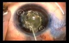 Capsulotomy in a small eye with use of Fugo Blade 