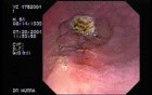 Barrett's Esophagus 