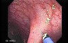 Juvenile Non Familial Polyposis of the Colon (37 of 37)