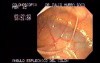 Splenic Flexure (2 of 2)