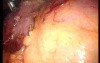 Gastrointestinal Stromal Tumor - GIST (25 of 65)