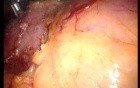 Gastrointestinal Stromal Tumor - GIST (25 of 65)