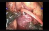 Robotic Spleen Preserving Distal Pancreatectomy