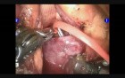 Robotic Spleen Preserving Distal Pancreatectomy