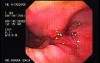 Intraluminal Endoscopic Suturing - Assessment of the First Gastroplicature, Part 2