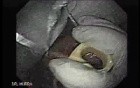 Achalasia - Guidewire For Esophageal Dilation - 2/4
