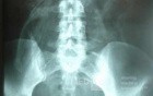 Intragastric Balloon Migration