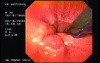 Flexible Endoscopic Suturing - One Part of the Procedure