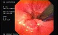Flexible Endoscopic Suturing - One Part of the Procedure