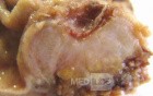 Adenocarcinoma of the Antrum and incisura angularis (5 of 12)