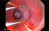 Esophageal Varix - Banding of Varices