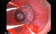 Esophageal Varix - Banding of Varices