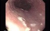 Candida Esophagitis - Endoscopy - Fungal Overgrowth