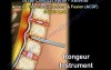 Cervical Spine - Decompression And Fusion