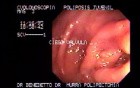 Non Familial Juvenile Polyposis Of The Colon (6 of 37)